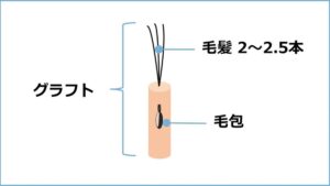 自毛植毛クリニック徹底比較 グラフトとは