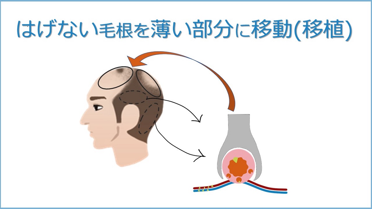 手術した後は半永久的に生え続ける自毛植毛の仕組み