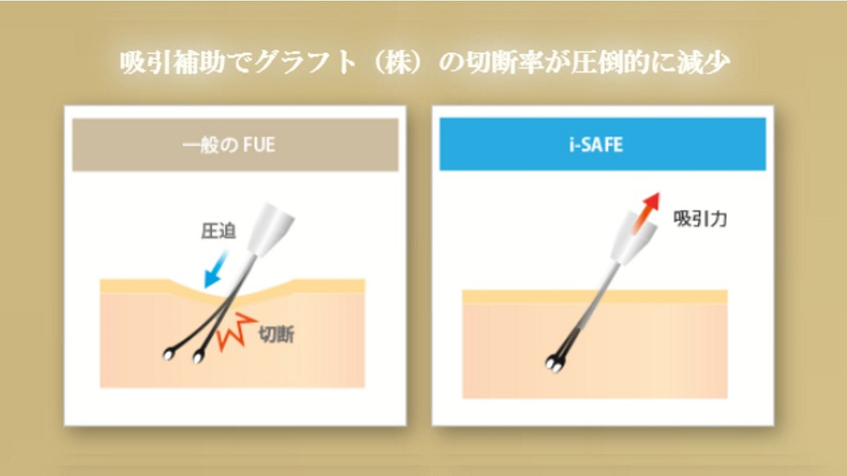 アスク井上クリニック自毛植毛体験談 i SAFE 吸引力