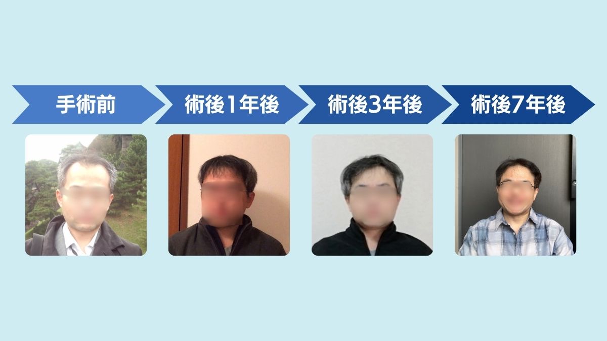 アスク井上クリニック自毛植毛経過